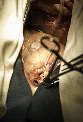 أول عملية قلب مفتوح مباشرة عبر موقع التويتر